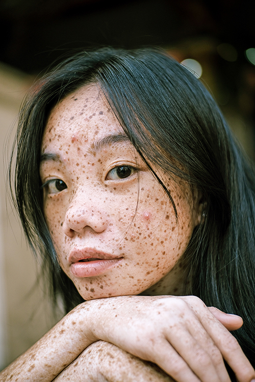 Hyperpigmentation